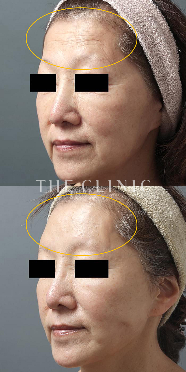 額のシワのコンデンスリッチフェイス(顔の脂肪注入)（59歳女性）の術前・術後写真