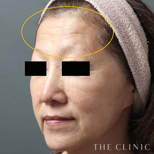 額のシワのコンデンスリッチフェイス(顔の脂肪注入)（59歳女性）の術前写真