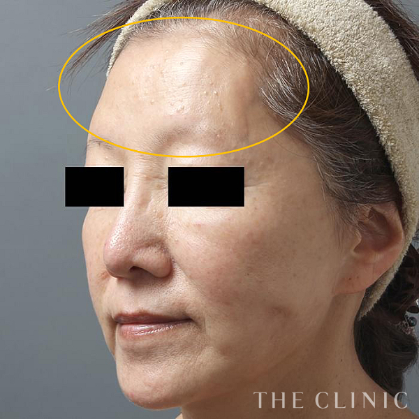 額のシワのコンデンスリッチフェイス(顔の脂肪注入)（59歳女性）の術後写真