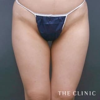 【THE CLINIC 症例画像】No.16_1_太もも_360脂肪吸引®(執刀医:大橋 昌敬)