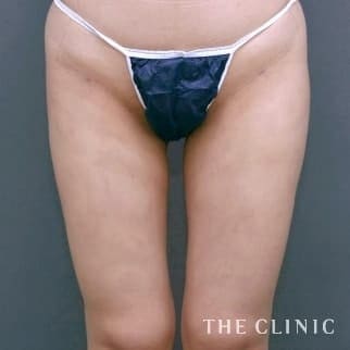 【THE CLINIC 症例画像】No.16_2_太もも_ベイザー脂肪吸引(執刀医：大橋 昌敬)