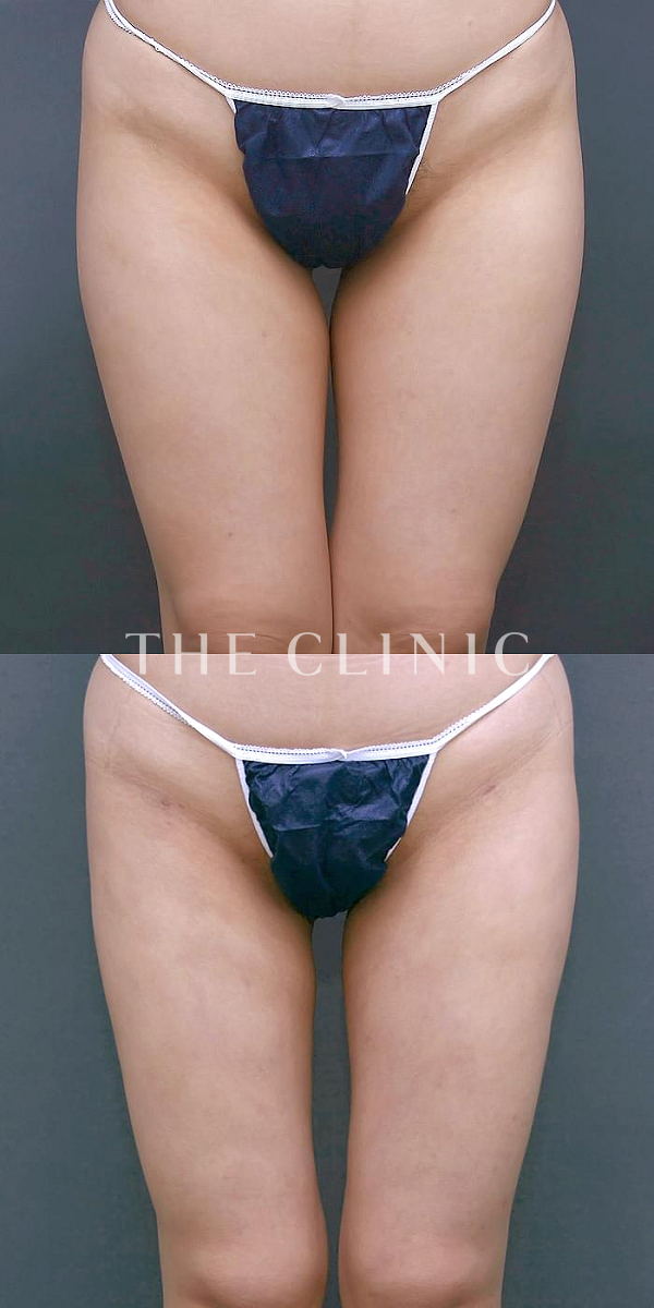 太もものベイザー脂肪吸引（41歳女性）の術前・術後写真