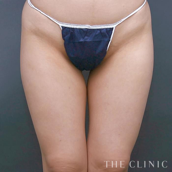 太もものベイザー脂肪吸引（41歳女性）の術前写真