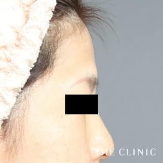 おでこ(額)のくぼみのコンデンスリッチフェイス(顔の脂肪注入)のモニター(40代)術前症例画像