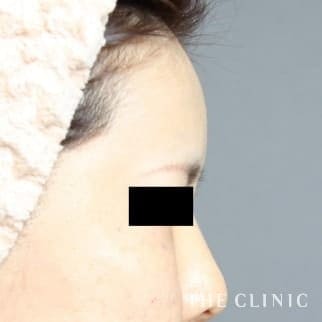 おでこ(額)のくぼみのコンデンスリッチフェイス(顔の脂肪注入)のモニター（40代）術後症例画像