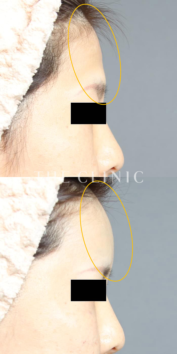 おでこ(額)のくぼみのコンデンスリッチフェイス(顔の脂肪注入)（41歳女性）の術前・術後写真