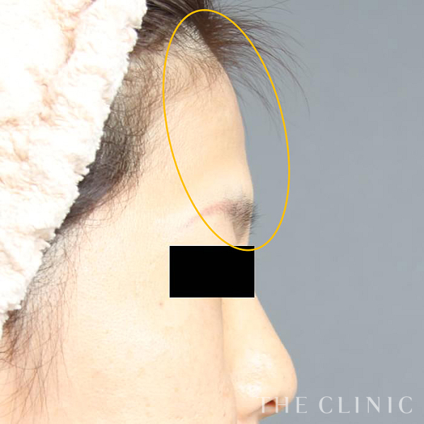 おでこ(額)のくぼみのコンデンスリッチフェイス(顔の脂肪注入)（41歳女性）の術前写真