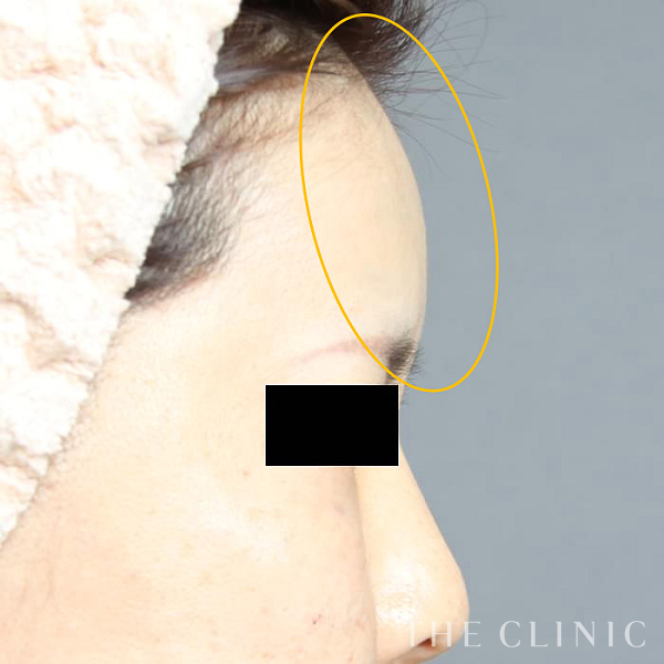 おでこ(額)のくぼみのコンデンスリッチフェイス(顔の脂肪注入)（41歳女性）の術後写真