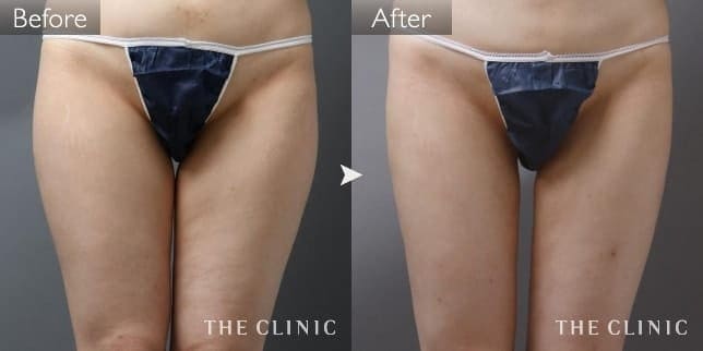 脂肪吸引 太もも 症例写真