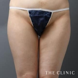 【THE CLINIC 症例画像】No.18_1_太もも_360脂肪吸引®(執刀医:大橋 昌敬)