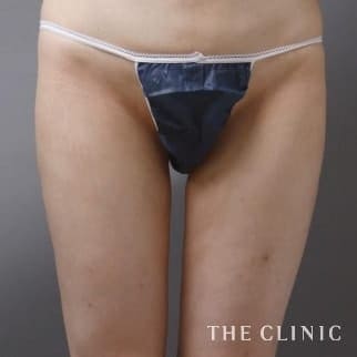 【THE CLINIC 症例画像】No.18_2_太もも_360脂肪吸引®(執刀医:大橋 昌敬)