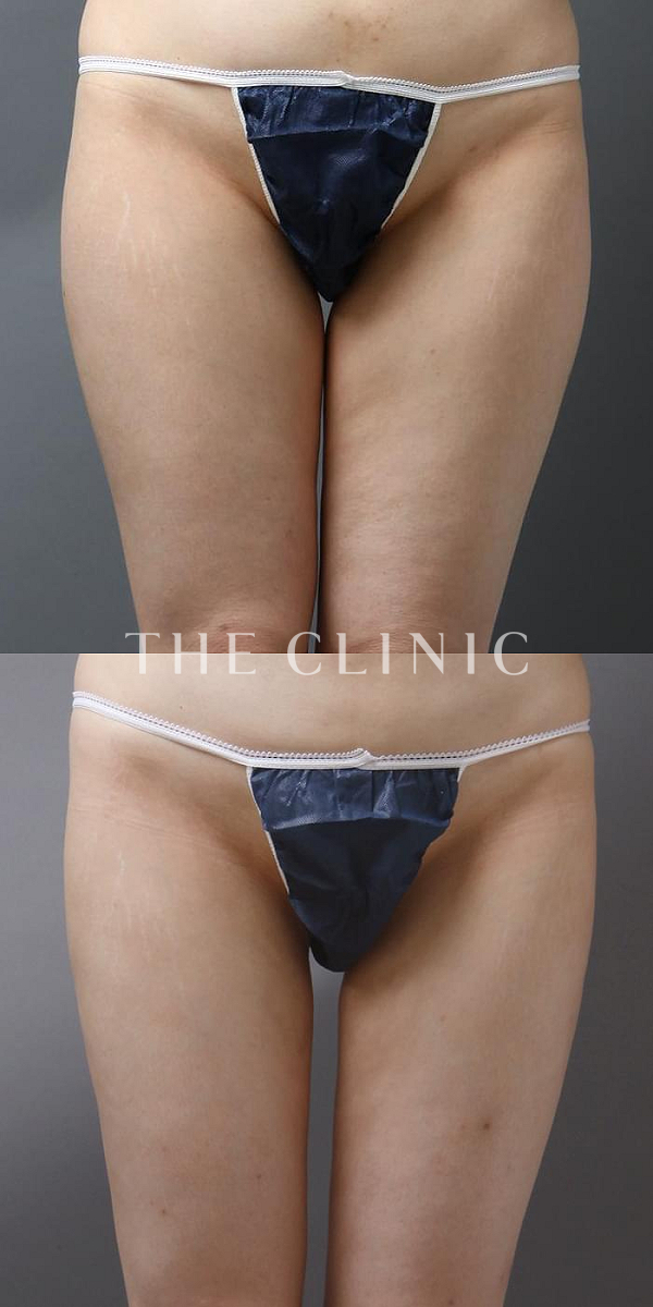 太もものベイザー脂肪吸引（36歳女性）の術前・術後写真