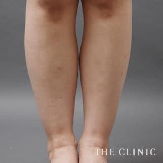 【THE CLINIC 症例画像】No.19_1_ふくらはぎ_360脂肪吸引®
