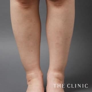 【THE CLINIC 症例画像】No.19_2_ふくらはぎ_360脂肪吸引®