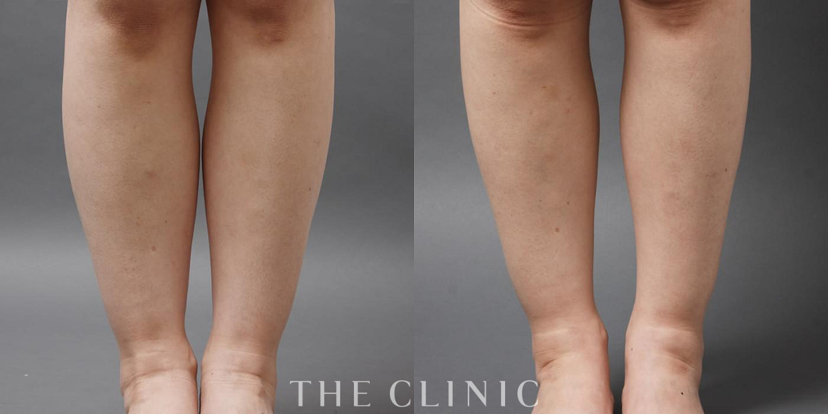 360脂肪吸引®の術前／術後