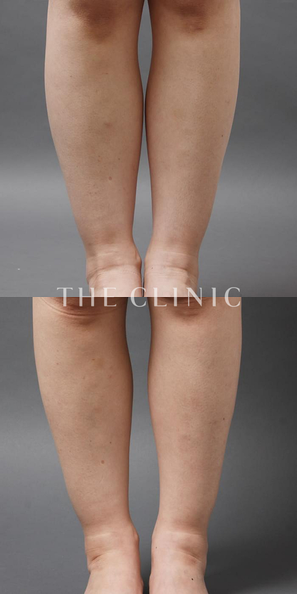 ふくらはぎの360脂肪吸引®（45歳女性）の術前・術後写真