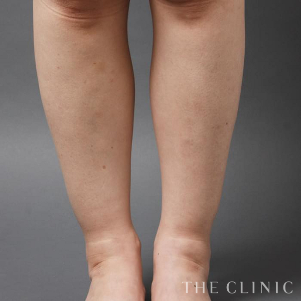ふくらはぎの360脂肪吸引®（45歳女性）の術後写真