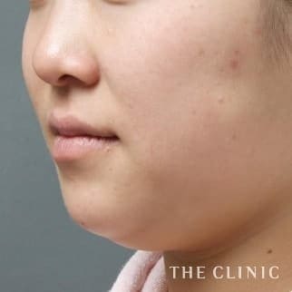 【THE CLINIC 症例画像】No.1_1_頰/顎_360脂肪吸引®(執刀医:大橋 昌敬)