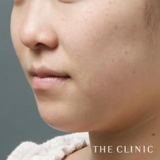 【THE CLINIC 症例画像】No.1_2_頰/顎_ベイザー脂肪吸引(執刀医:大橋 昌敬)