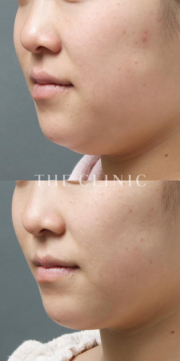 頰／顎のベイザー脂肪吸引（23歳女性）の術前・術後写真