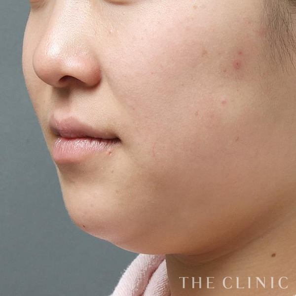 頰／顎のベイザー脂肪吸引（23歳女性）の術前写真