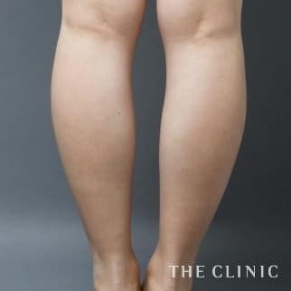 【THE CLINIC 症例画像】No.20_1_ふくらはぎ_360脂肪吸引®(執刀医:大橋 昌敬)