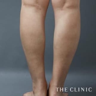足首のベイザー脂肪吸引 術後症例画像（35歳／女性）