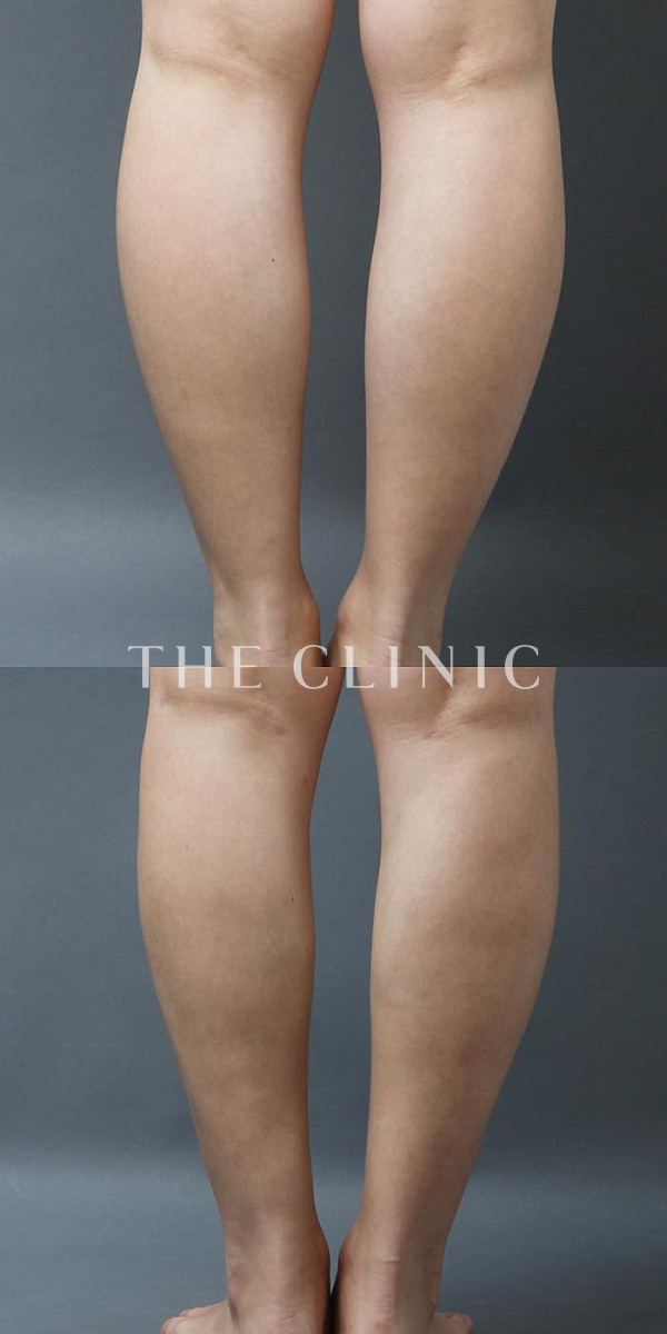 ふくらはぎのベイザー脂肪吸引（35歳女性）の術前・術後写真
