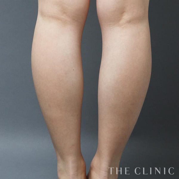 ふくらはぎのベイザー脂肪吸引（35歳女性）の術前写真