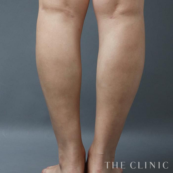 ふくらはぎのベイザー脂肪吸引（35歳女性）の術後写真