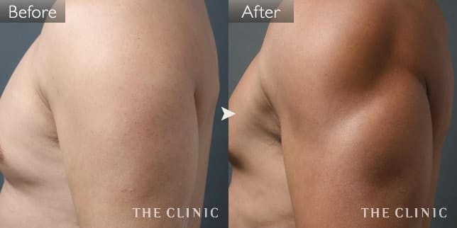 上腕のデザイン(男性/42歳)