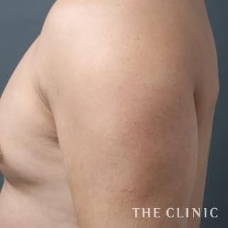 【THE CLINIC 症例画像】No.21_1_上腕のデザイン_ベイザー4D(男性のシックスパック脂肪吸引)