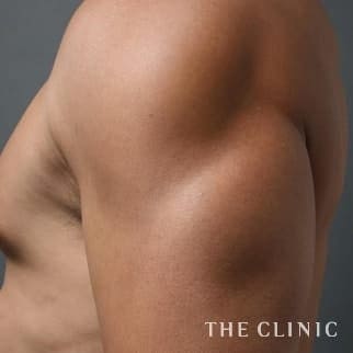 【THE CLINIC 症例画像】No.21_2_上腕のデザイン_ベイザー4D(男性のシックスパック脂肪吸引)