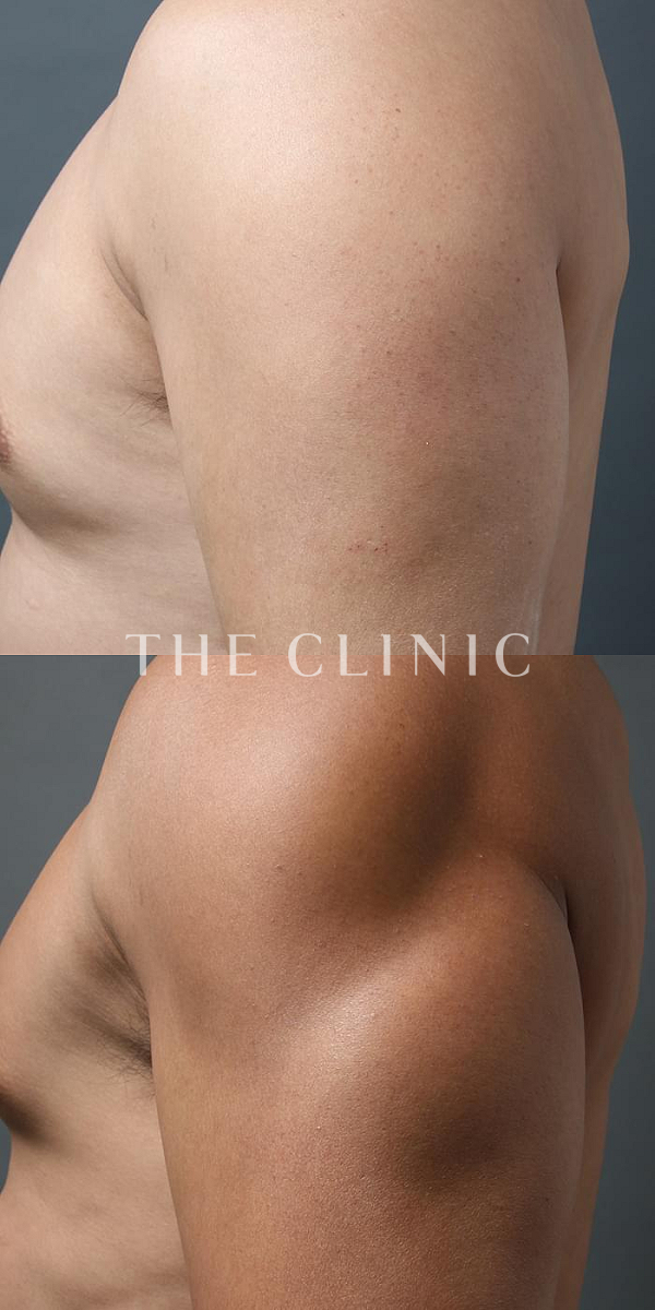 上腕のデザインのベイザー4D(男性のシックスパック脂肪吸引)（42歳男性）の術前・術後写真