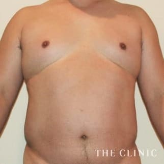 【THE CLINIC 症例画像】No.22_1_SIX PACK 6つに割れた腹筋_ベイザー4D(男性のシックスパック脂肪吸引)