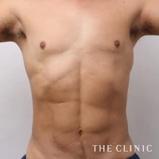 【THE CLINIC 症例画像】No.22_2_SIX PACK 6つに割れた腹筋_ベイザー4D(男性のシックスパック脂肪吸引)