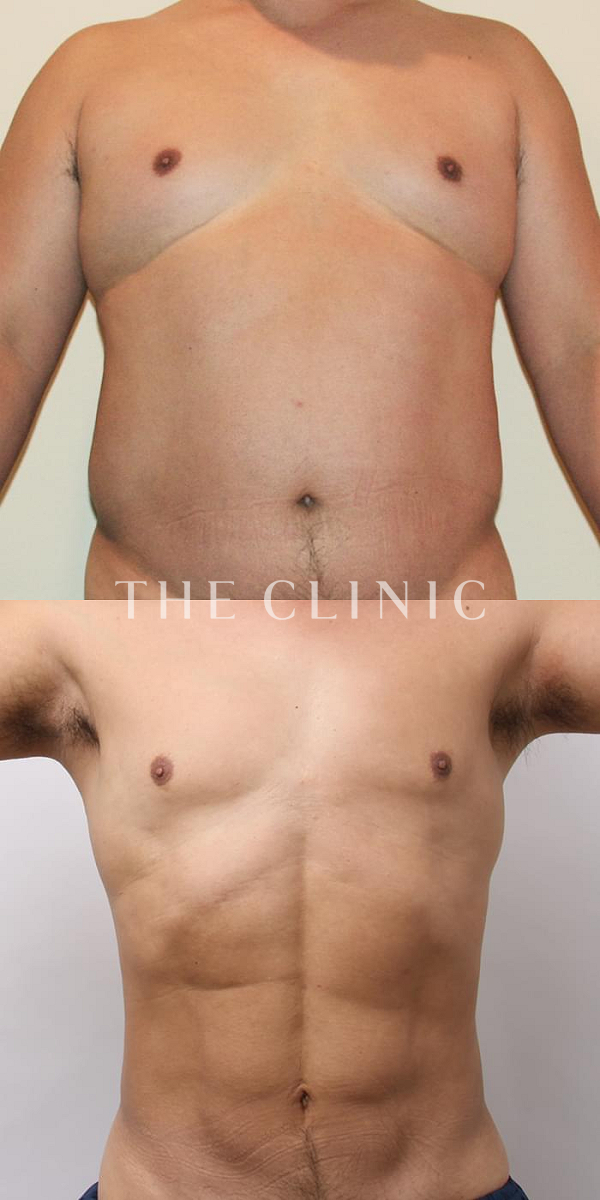 SIX PACK ６つに割れた腹筋のベイザー4D(男性のシックスパック脂肪吸引)（46歳男性）の術前・術後写真