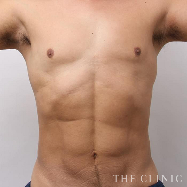 SIX PACK ６つに割れた腹筋のベイザー4D(男性のシックスパック脂肪吸引)（46歳男性）の術後写真