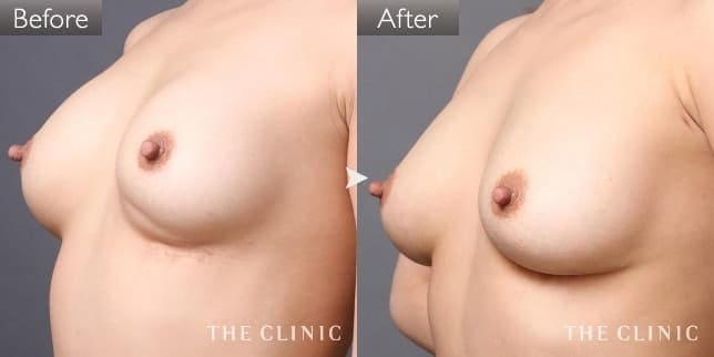 シリコンバッグ抜去(女性/30歳)