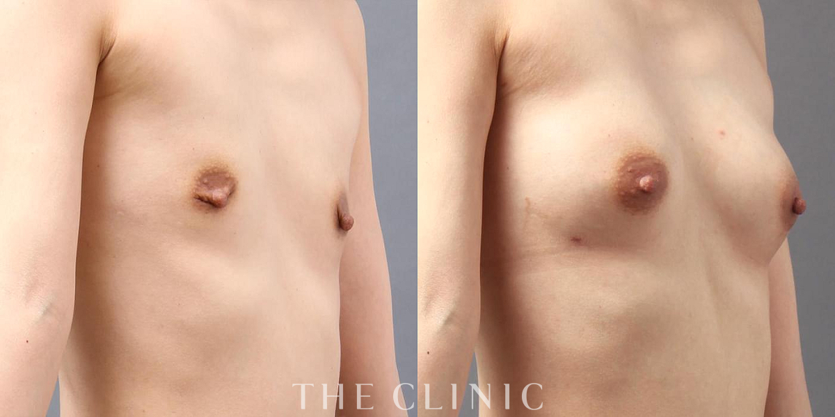 コンデンスリッチ豊胸の術前/術後