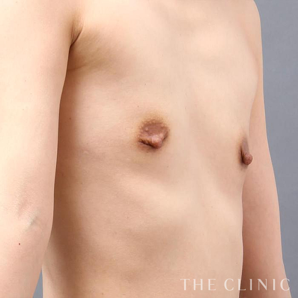 授乳後のたるみのコンデンスリッチ豊胸（32歳女性）の術前写真