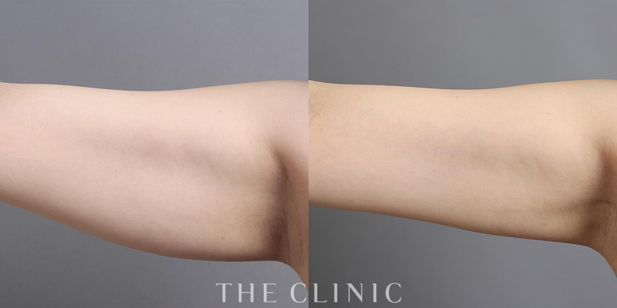 360脂肪吸引®の術前／術後