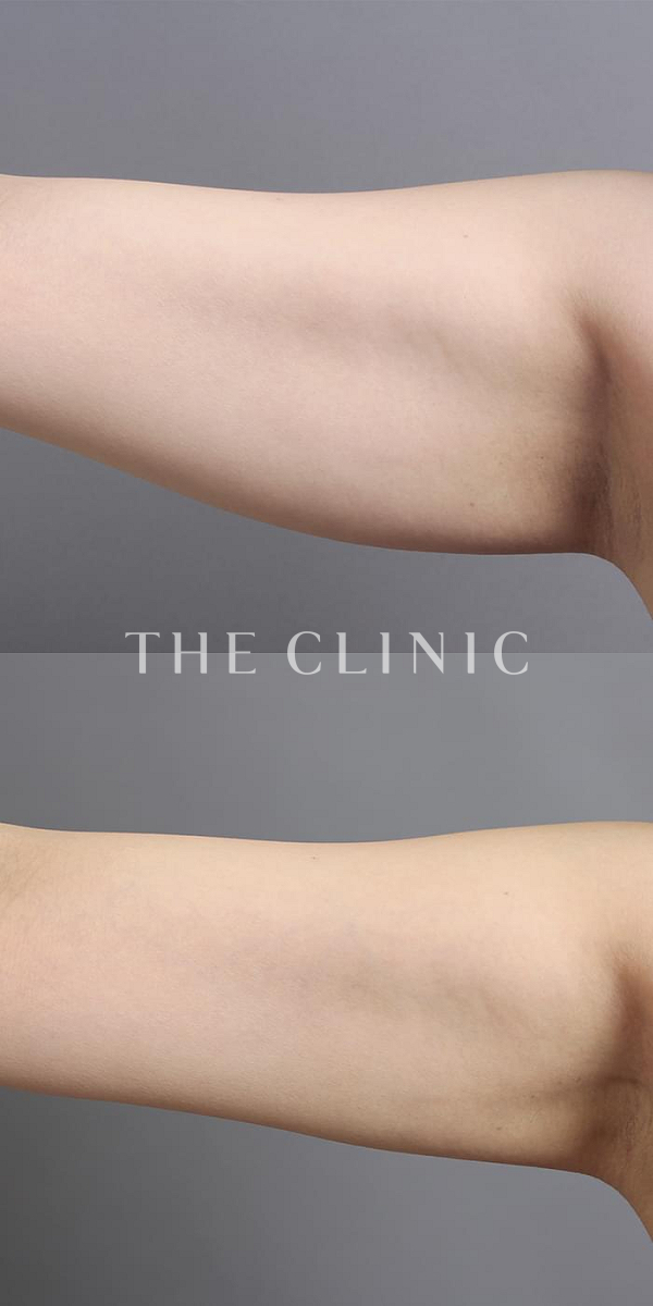 二の腕の360脂肪吸引®（38歳女性）の術前・術後写真