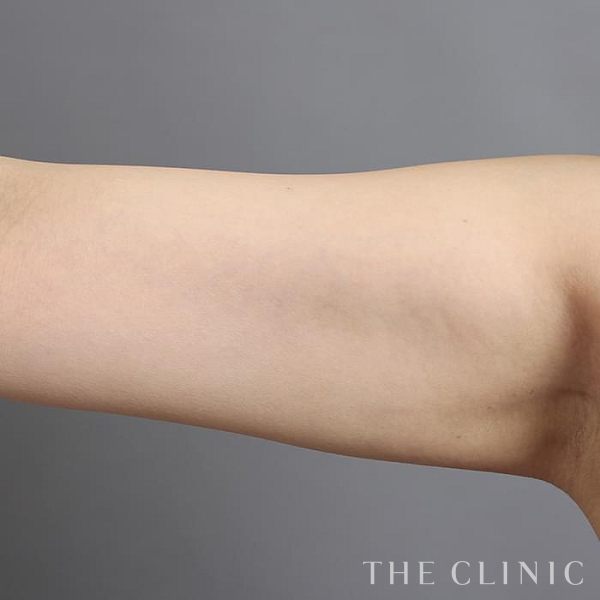 二の腕の360脂肪吸引®（38歳女性）の術後写真