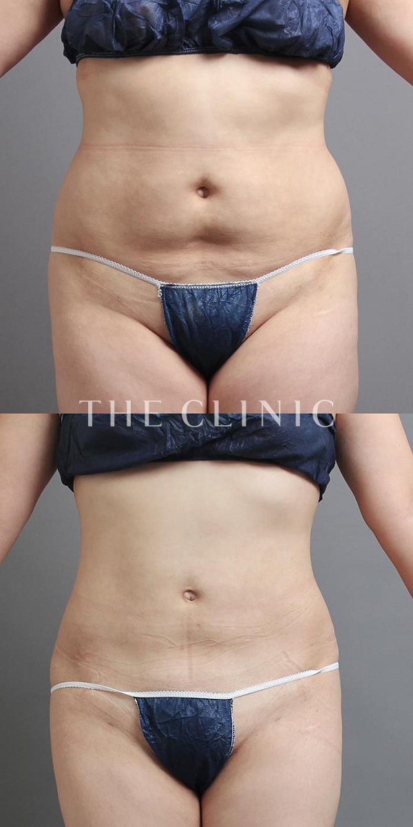 腹部のベイザー脂肪吸引（29歳女性）の術前・術後写真