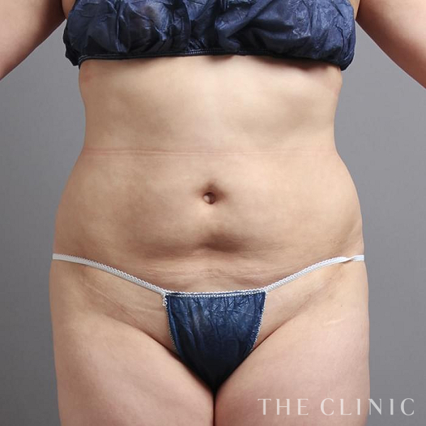 腹部のベイザー脂肪吸引（29歳女性）の術前写真