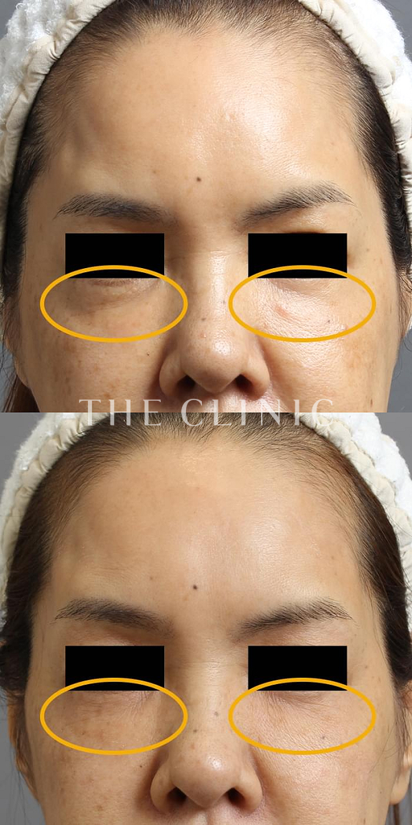 目の下のクマのマイクロCRF注入(顔の脂肪注入)（54歳女性）の術前・術後写真