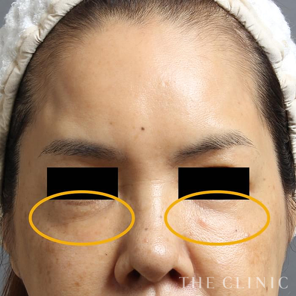 目の下のクマのマイクロCRF注入(顔の脂肪注入)（54歳女性）の術前写真