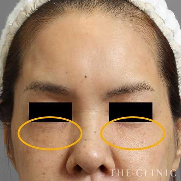 目の下のクマのマイクロCRF注入(顔の脂肪注入)（54歳女性）の術後写真