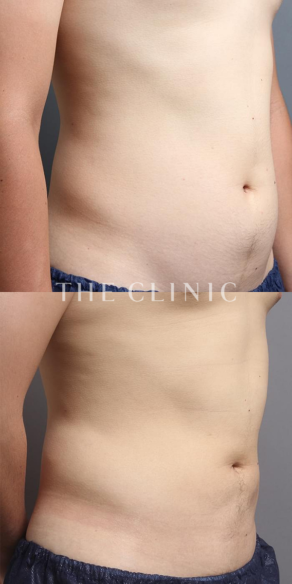 腹部の360脂肪吸引®（22歳男性）の術前・術後写真